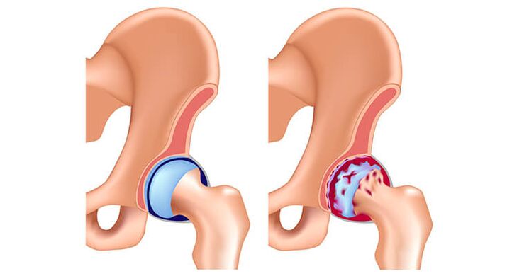 Hüftgelenk -Osteoarthritis